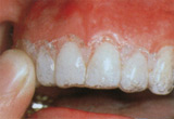 whitening4